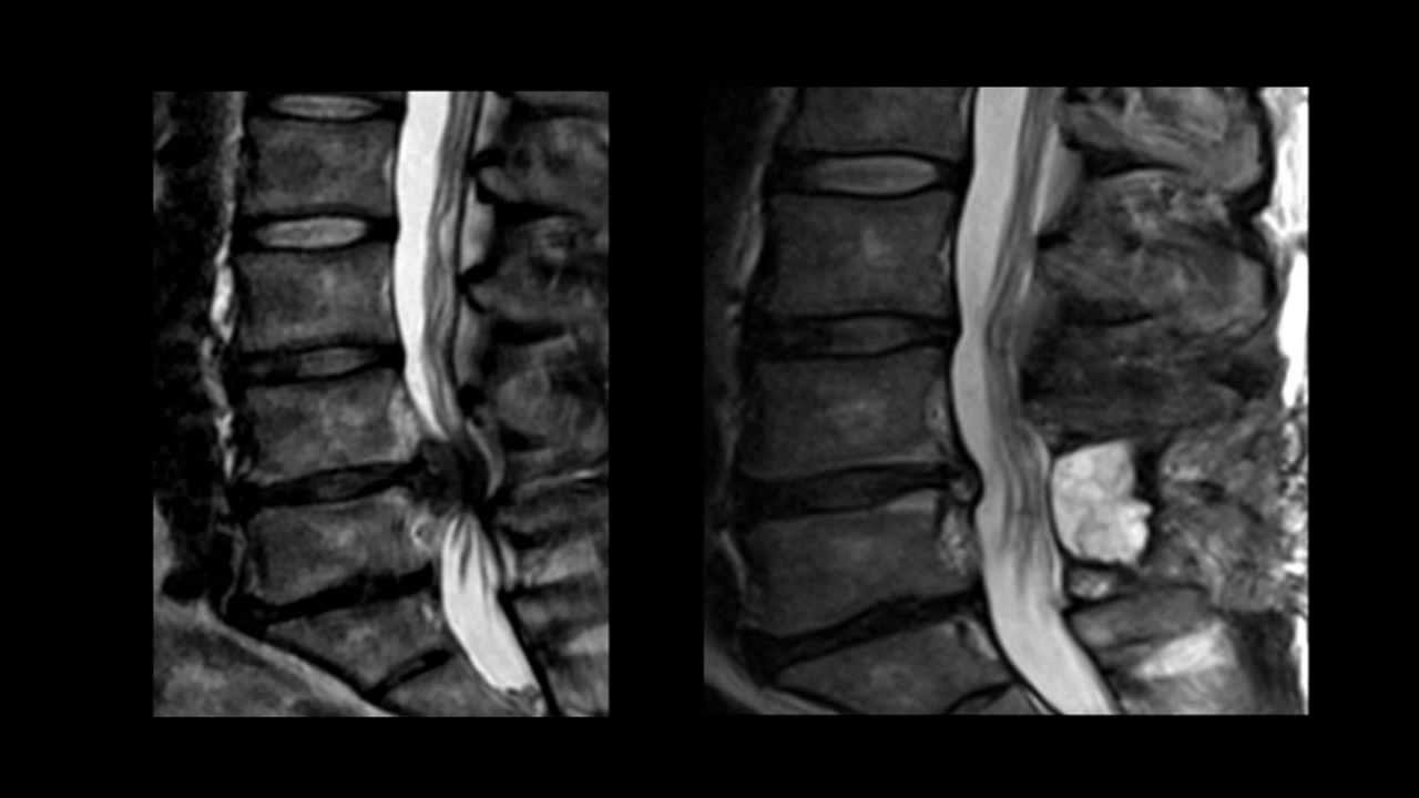 cauda equina syndrome turner freeman lawyers