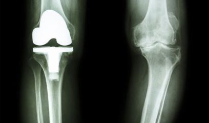 Time limits lifted on knee replacements