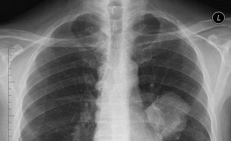 mesothelioma from asbestos exposure