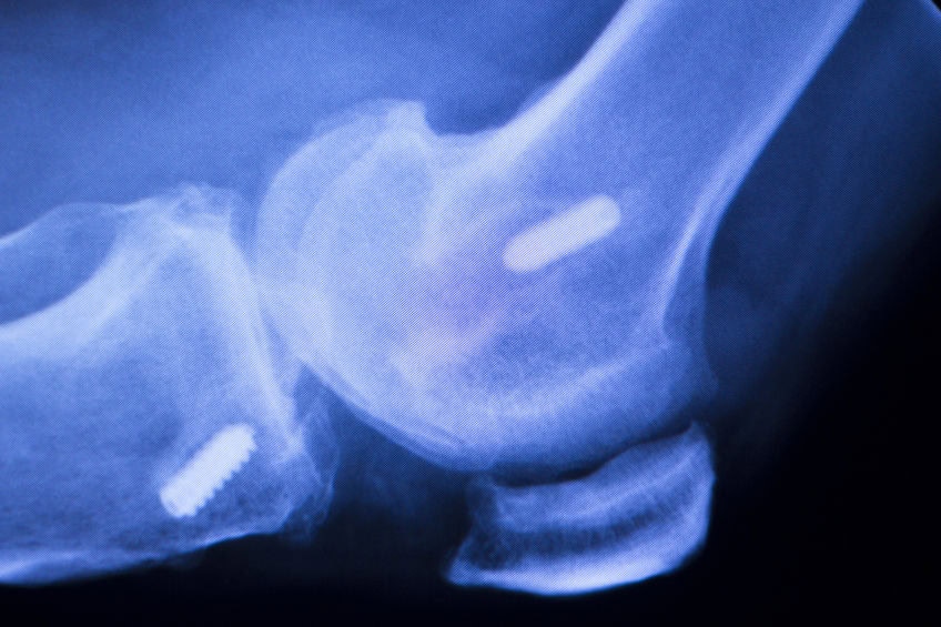 Medical device negligence