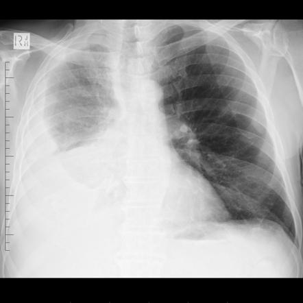 mesothelioma from asbestos exposure