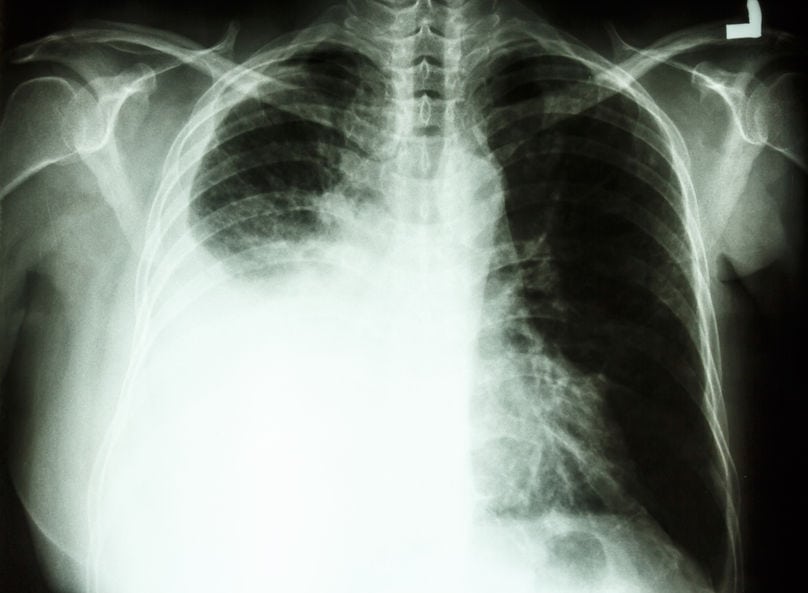 Silicosis from asbestos exposure