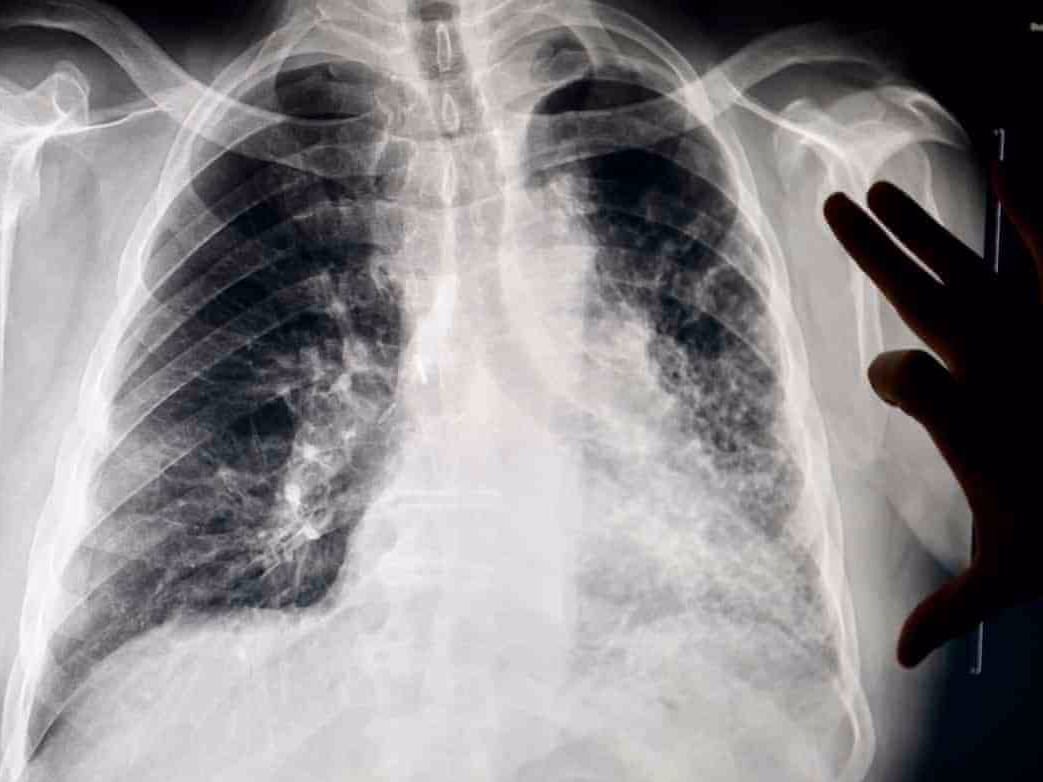 Silicosis from cutting stone