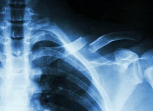 workplace injury from asbestos exposure